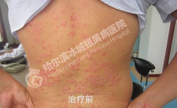 寻常型银屑病图片