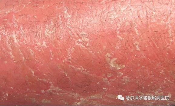 红皮型牛皮癣图片