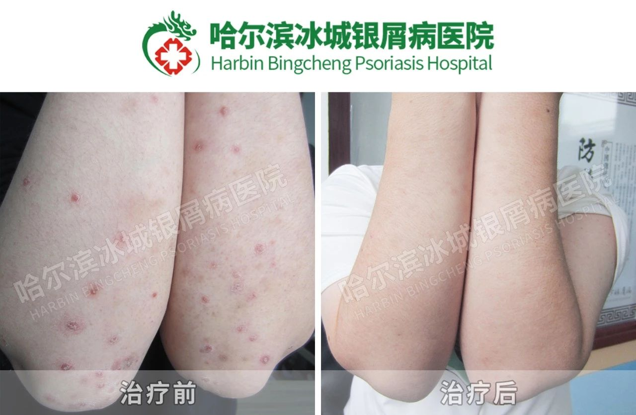 哈尔滨牛皮癣专科医院